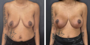 before and after breast lift with augmentation front view case 1625
