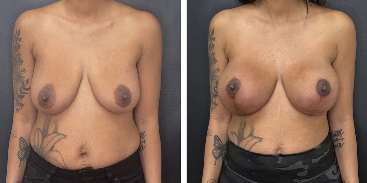 before and after breast lift with augmentation front view case 1625