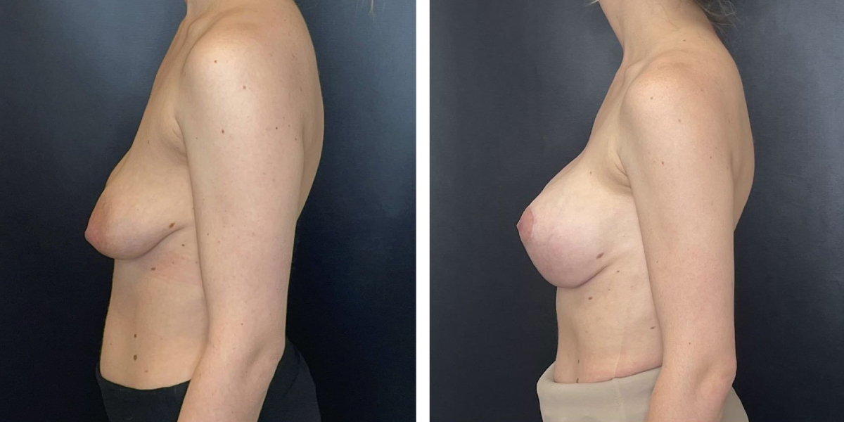 before and after breast lift with augmentation left side view case 1632