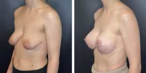 before and after breast lift with augmentation left angled view case 1632