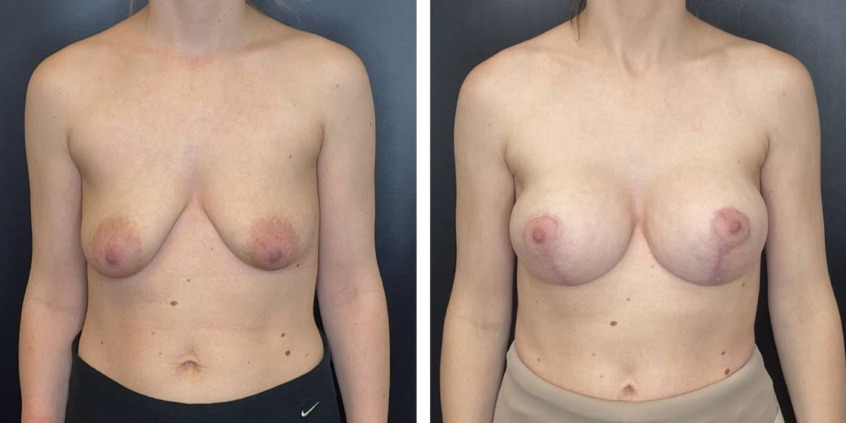 before and after breast lift with augmentation front view case 1632