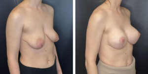 before and after breast lift with augmentation right angled view case 1632