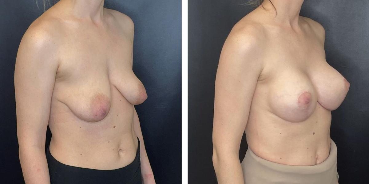 before and after breast lift with augmentation right angled view case 1632
