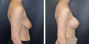 before and after breast lift with augmentation right side view case 1632