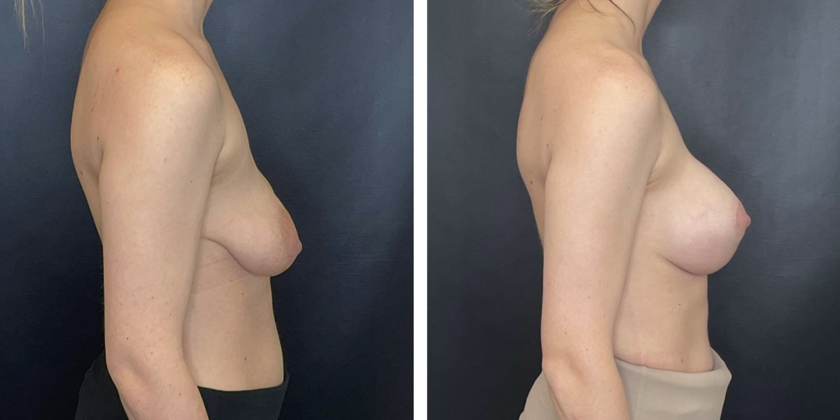 before and after breast lift with augmentation right side view case 1632