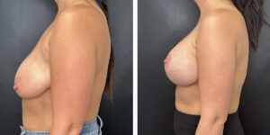 before and after breast lift with augmentation left side view case 1638