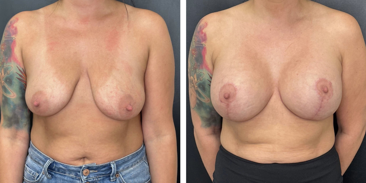 before and after breast lift with augmentation front view case 1638