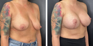 before and after breast lift with augmentation right angled view case 1638