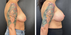 before and after breast lift with augmentation right side view case 1638