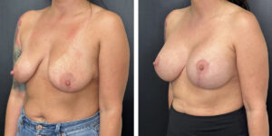 before and after breast lift with augmentation left angled view case 1638
