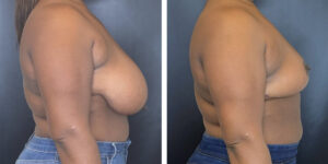 before and after breast reduction right side view case 1250