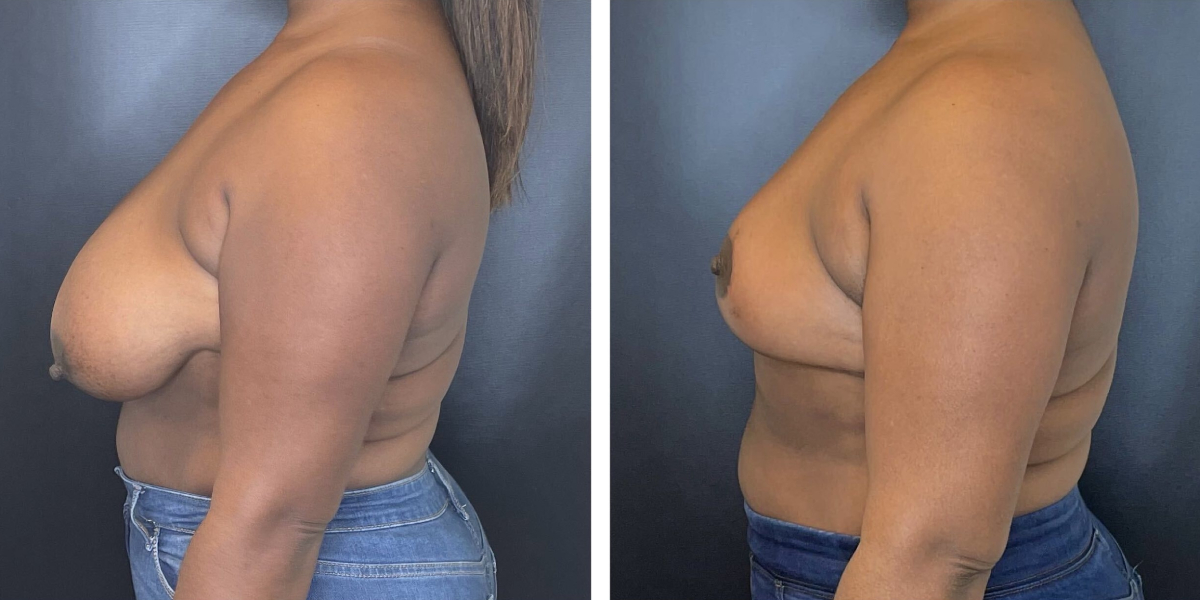 before and after breast reduction left side view case 1250