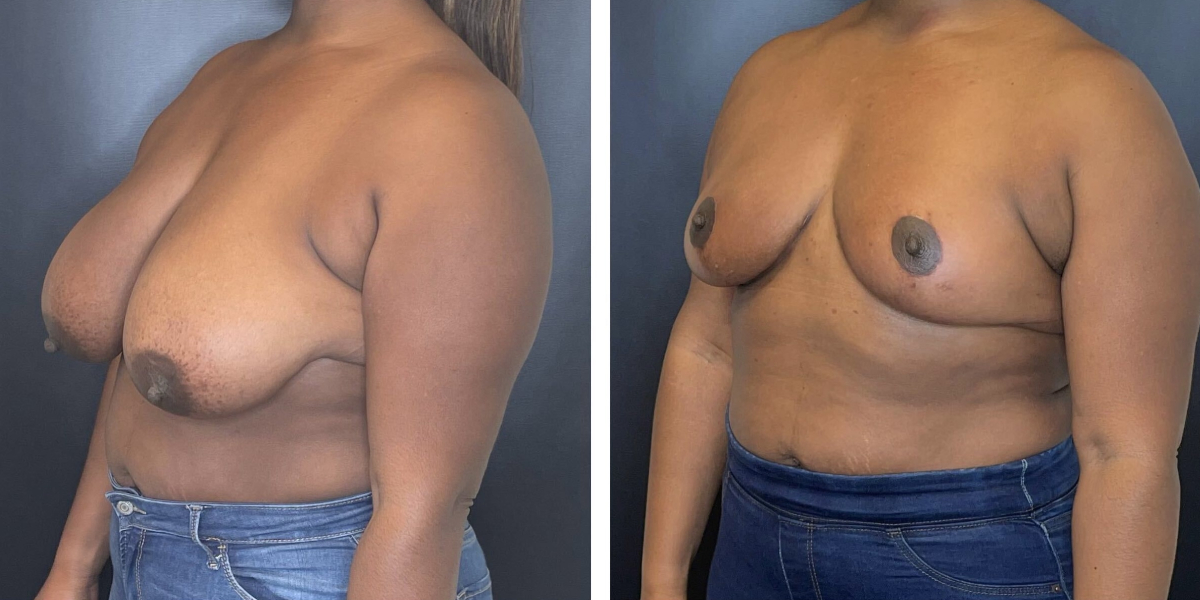 before and after breast reduction left angled view case 1250