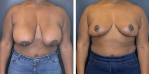 before and after breast reduction front view case 1250