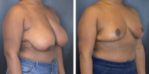 before and after breast reduction right angled view case 1250
