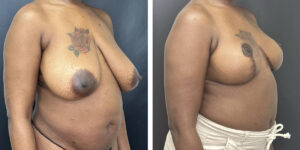 before and after breast reduction right angled view case 1256
