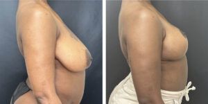before and after breast reduction right side view case 1256