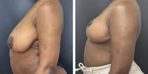 before and after breast reduction left side view case 1256