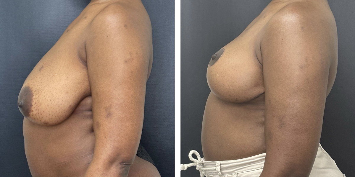 before and after breast reduction left side view case 1256
