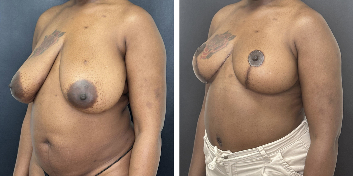 before and after breast reduction left angled view case 1256