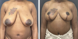 before and after breast reduction front view case 1256