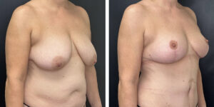 before and after breast reduction right angled view case 1262