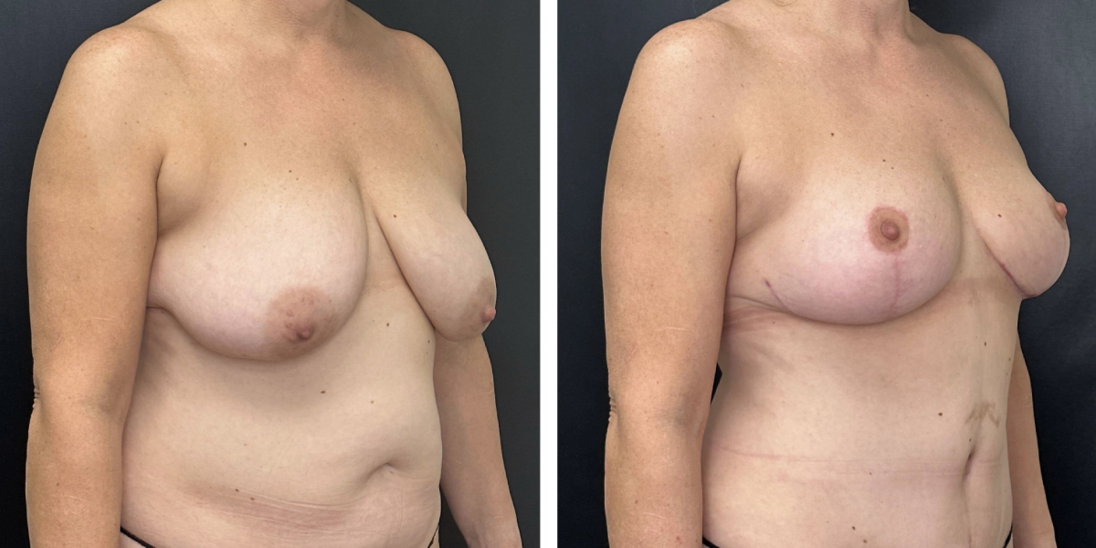 before and after breast reduction right angled view case 1262