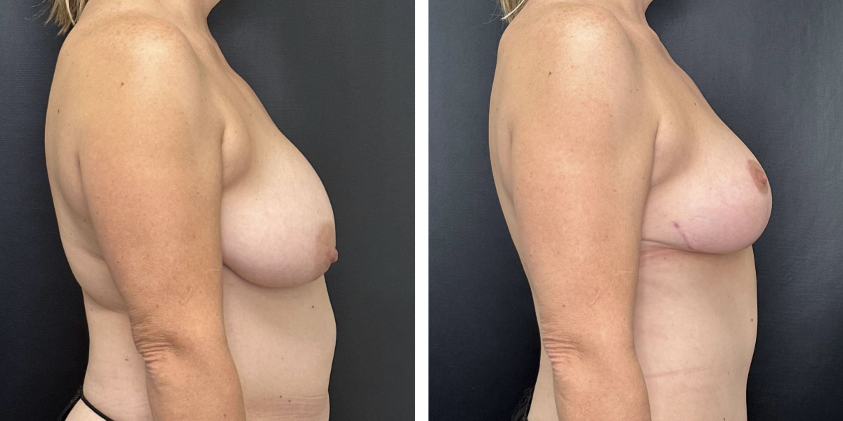 before and after breast reduction right side view case 1262