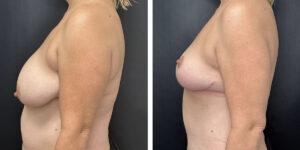 before and after breast reduction left side view case 1262