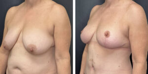 before and after breast reduction left angled view case 1262
