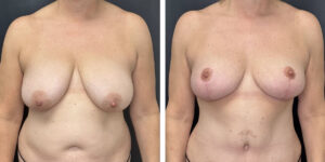 before and after breast reduction front view case 1262