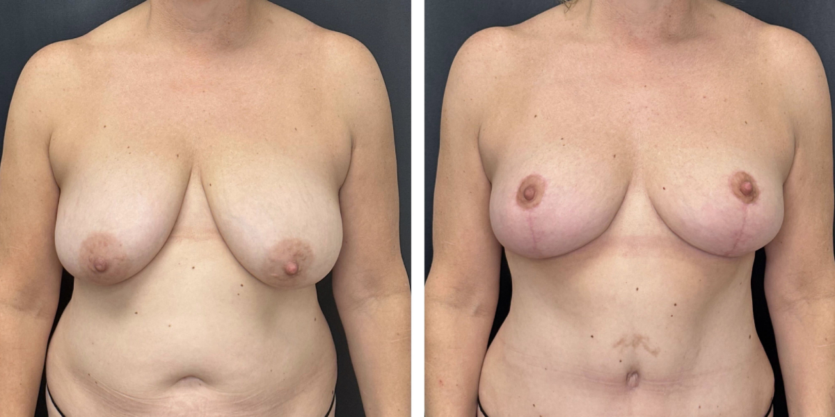 before and after breast reduction front view case 1262