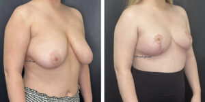 before and after breast reduction right angled view case 1268