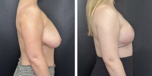 before and after breast reduction right side view case 1268