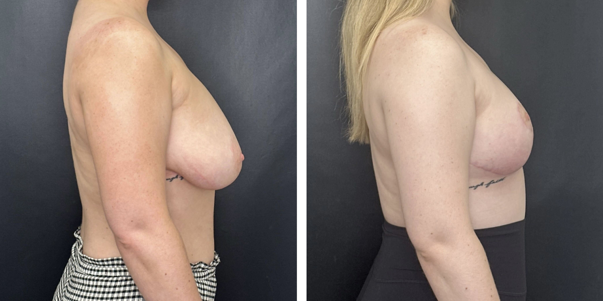 before and after breast reduction right side view case 1268