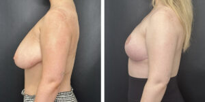 before and after breast reduction left side view case 1268