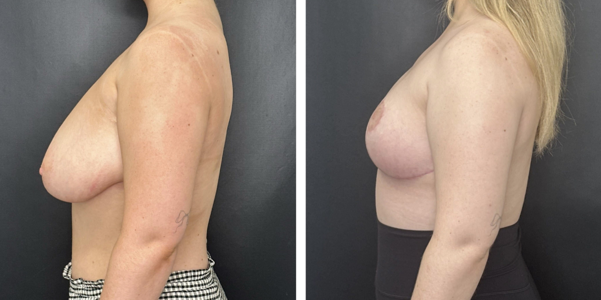 before and after breast reduction left side view case 1268