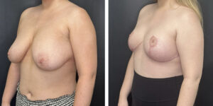 before and after breast reduction left angled view case 1268