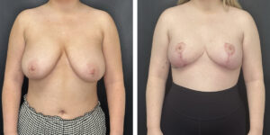 before and after breast reduction front view case 1268
