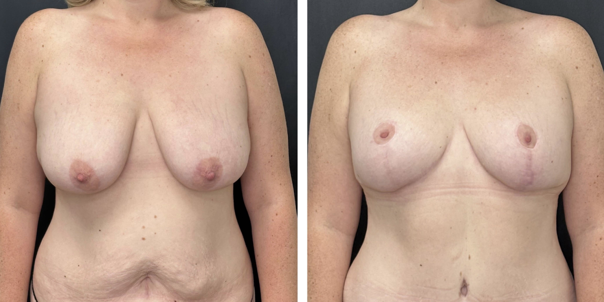 before and after breast reduction front view case 1274