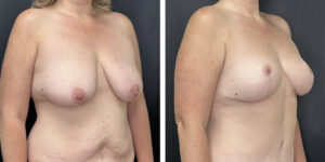 before and after breast reduction right angled view case 1274