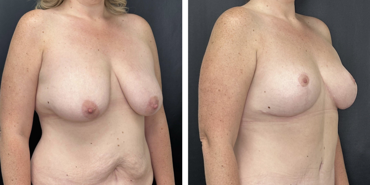 before and after breast reduction right angled view case 1274