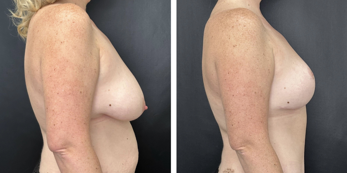 before and after breast reduction right side view case 1274