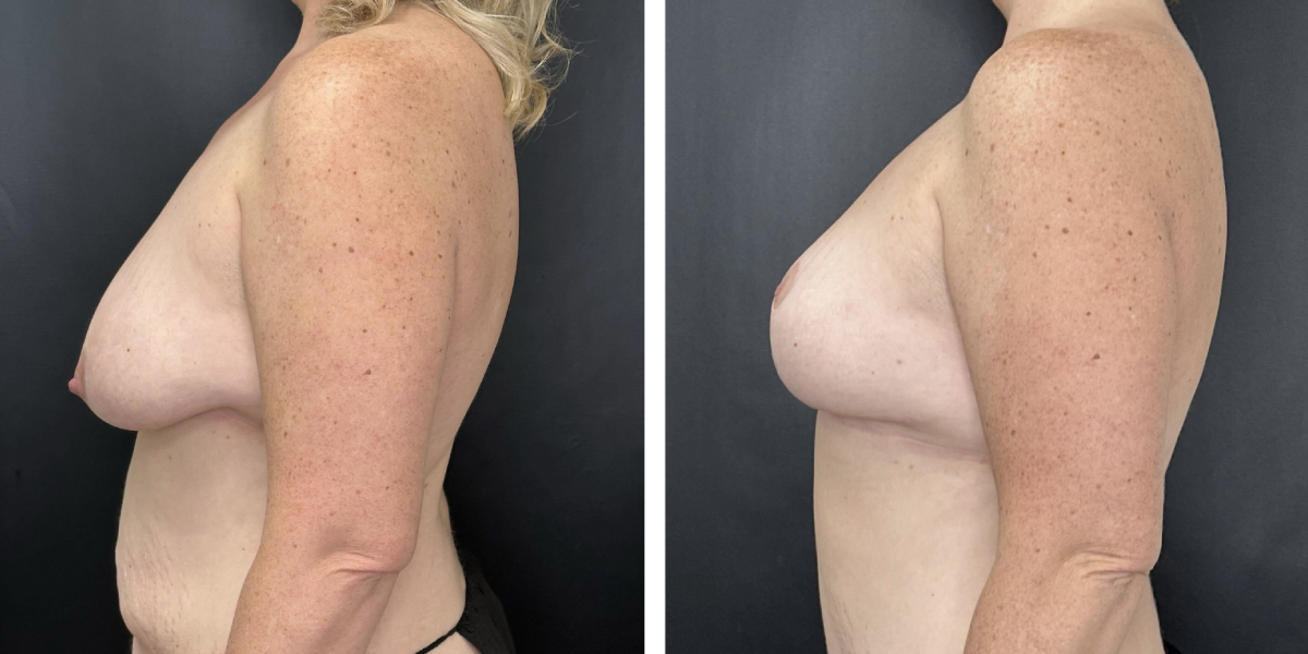 before and after breast reduction left side view case 1274