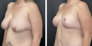 before and after breast reduction left angled view case 1274