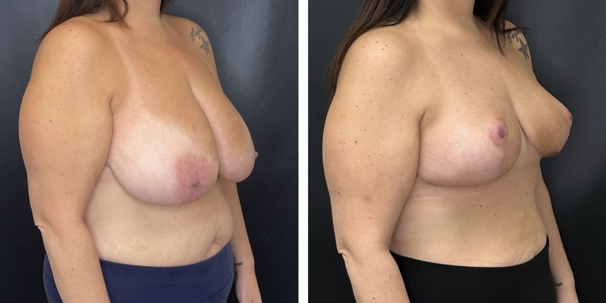 before and after breast reduction right angled view case 1280