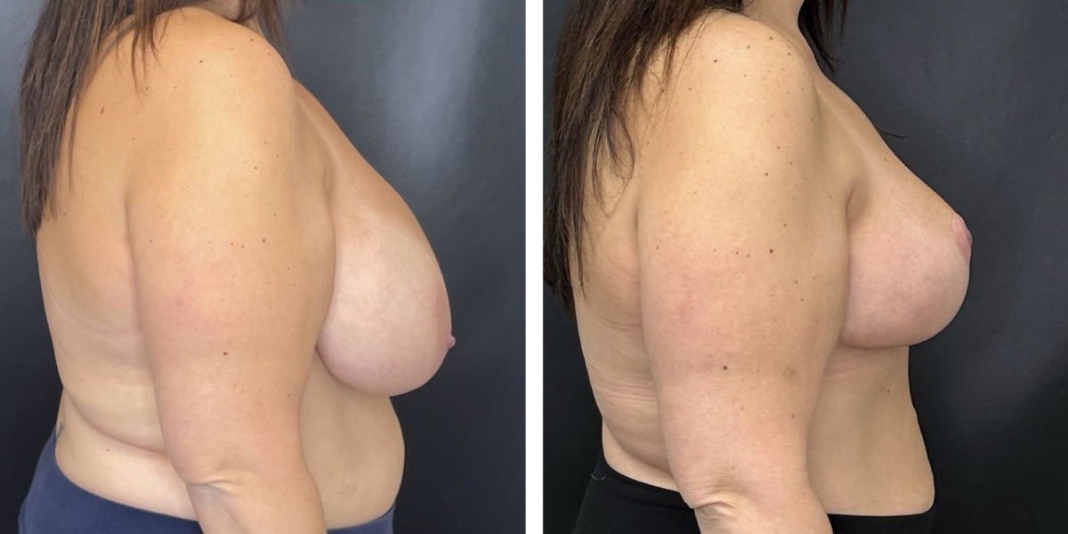 before and after breast reduction right side view case 1280