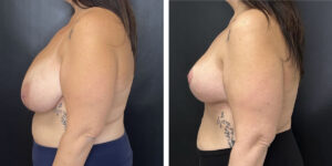 before and after breast reduction left side view case 1280