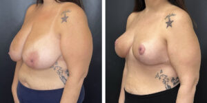 before and after breast reduction left angled view case 1280