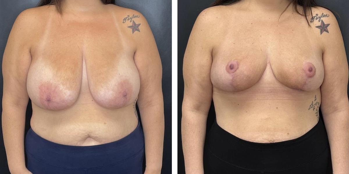 before and after breast reduction front view case 1280